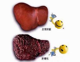 肝硬化患者的检查项目有哪些
