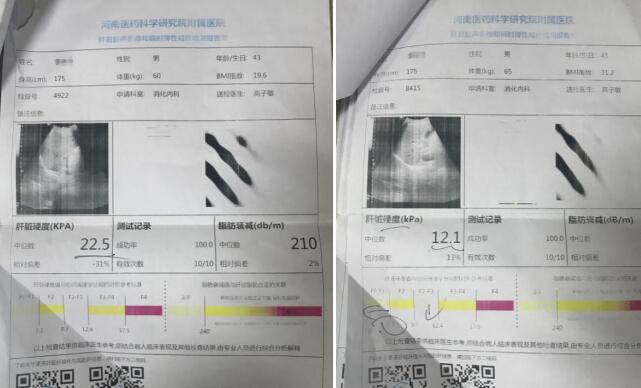 肝不硬了!患者临床应用专利软肝术 成功逆转肝硬化